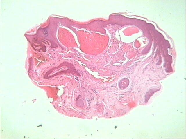 Fig.3 Angioqueratoma de la vulva - <div style=